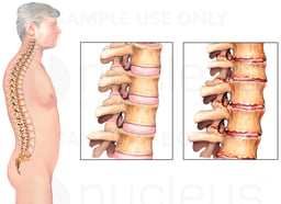 Ankylosing Spondylitis