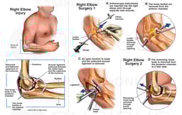 Right Elbow Injury with Open and Arthroscopic Surgeries