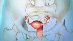 Managing Ovarian Cancer