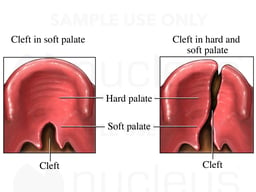 Cleft Palate