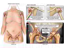 Multiple Severe Orthopedic Injuries