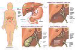 Correct vs. Incorrect Cholecystectomy (Gallbladder Removal) Procedure