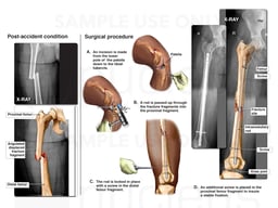 Closed Right Mid Shaft Fracture