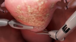 Robotic Hysterectomy