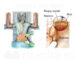 Bone Marrow Aspiration