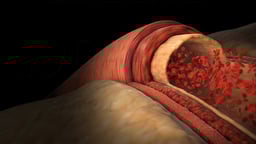 High Blood Pressure (Hypertension)