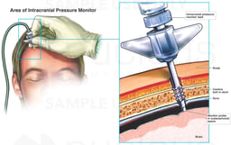 Brain Surgery - Placement of Intracranial Pressure Monitor