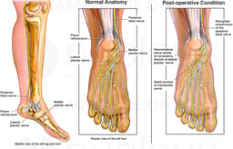 Post-operative Nerve Damage in to the Foot

