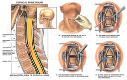 C5-6 Cervical Spine Injury with Surgical Anterior Cervical Discectomy and Fusion