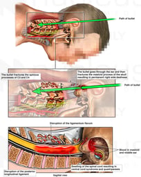 Gunshot Wound with Injury to Skull and Cervical Spine