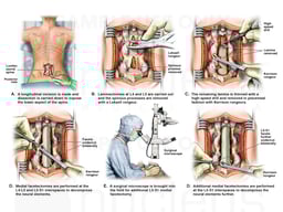 Laminectomies L4-L5, Bilateral Facetectomies L4-L5 and L5-S1, Microsurgical Technique.