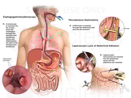 Multiple Abdominal Surgeries