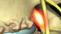 Nerve Root Compression