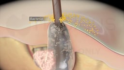 Bacterial Colonization of a Clogged Hair Follicle