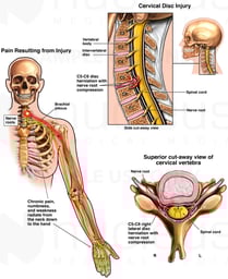 Cervical Disc Injury