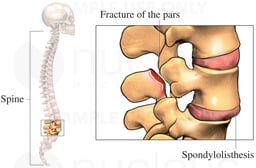 Spondylolisthesis