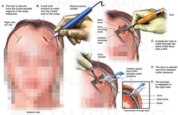 Drainage of Intracranial Fluid