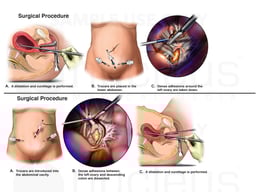 Dilation and Curettage Procedures
