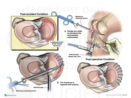 Right Medial Longitudinal Meniscal Tear with Arthroscopic Repair