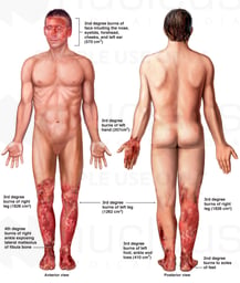 Front and Back Male Figures with Post-accident Burn Injuries