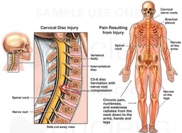 Spinal Cord Damage and C5-6 Disc Herniation Resulting in Chronic Neurological Deficits