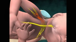 Birth Injury: Shoulder Dystocia with Brachial Plexus Stretching (Uterus Removed)