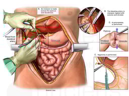 Laparotomy with Pyloroplasty and Vagotomy Procedures