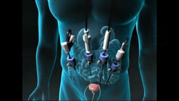 Radical Prostatectomy Surgical Approaches