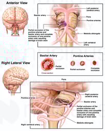 Arterial Occlusion with Resulting Brain Stem Damage