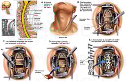Spine Surgery - C5-6 and C6-7 Anterior Cervical Discectomy with Spinal Fusion and Plating