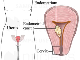 Endometrial Cancer
