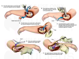 Radial Head Replacement and Tissue Reconstruction Surgery