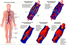Deep Vein Thrombosis