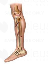 Post-op Tibia Fixation - lateral view