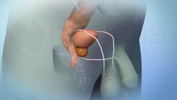 Treatment Options for Prostate Cancer