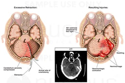 Excessive Retraction of the Cerebellum with Resulting Brain Injury