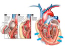 PICC Line Placement with Erosion of the atrial Wall and Resulting Cardiac Tamponade