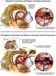 Craniotomy and Repair of Cerebral Aneurysm
