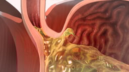 Pediatric Fundoplication