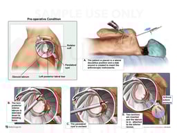 Left Shoulder Injuries with Arthroscopic Labral Repairs