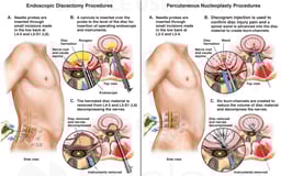 Lumbar Spine Surgeries