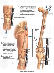 Surgical Fixation of the Left Femur and Patella