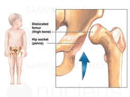 Child Hip Dysplasia