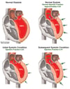 Heart Attack - Deteriorating Cardiac Ejection Volume Following Myocardial Infarction
