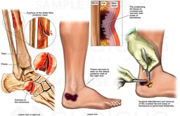 Foot and Ankle Injuries and Debridement of Necrotic Tissue