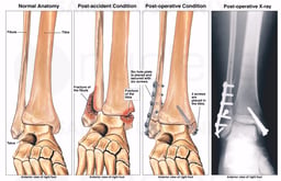 Bimalleolar Ankle Fracture with Subsequent Surgical Fixation
