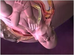 Brachial Plexus Birth Injury - Right Shoulder Dystocia (Erb's Palsy)