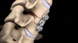 Anterior Cervical Discectomy and Fusion
