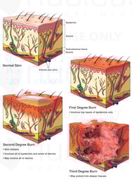 Classification of Skin Burns