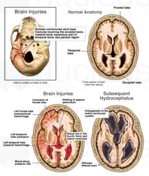 Skull and Brain Injuries with Subsequent Hydrocephalus